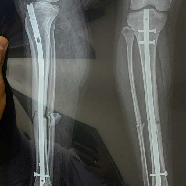 LeedsLimbCentre-Treatment-LimbReconstruction-OrthoplasticReconstruction