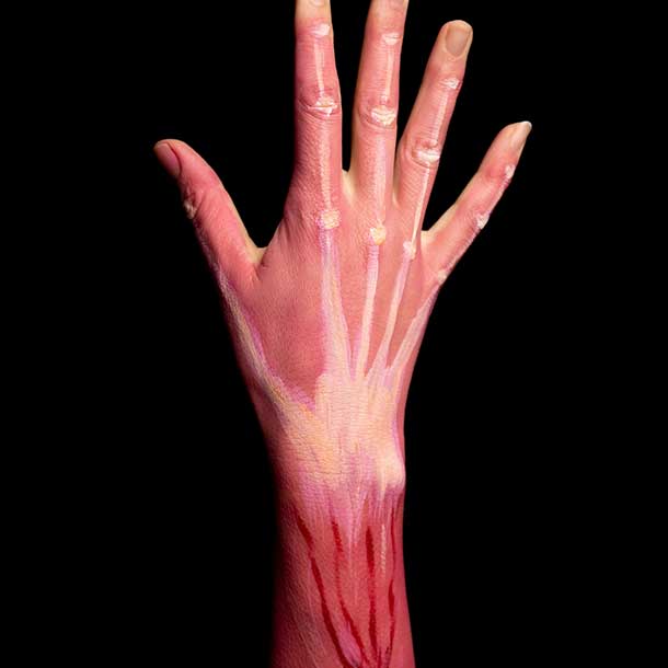 LeedsLimbCentre-Treatment-NerveSurgery-PainfulNeuromas-WithoutAmputation